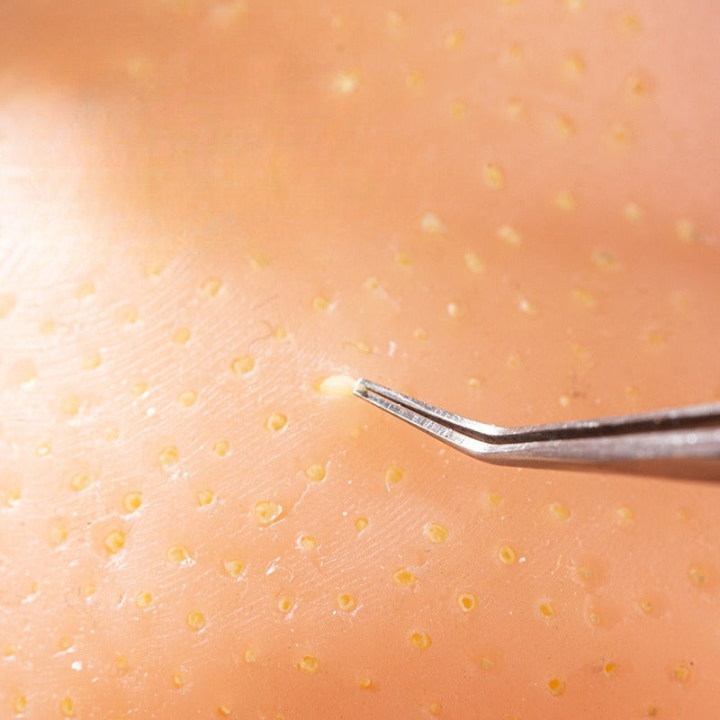 Eco-Friendly Realistic Acne Popping Stress Relief Toy Big Head Pimple Squeezer